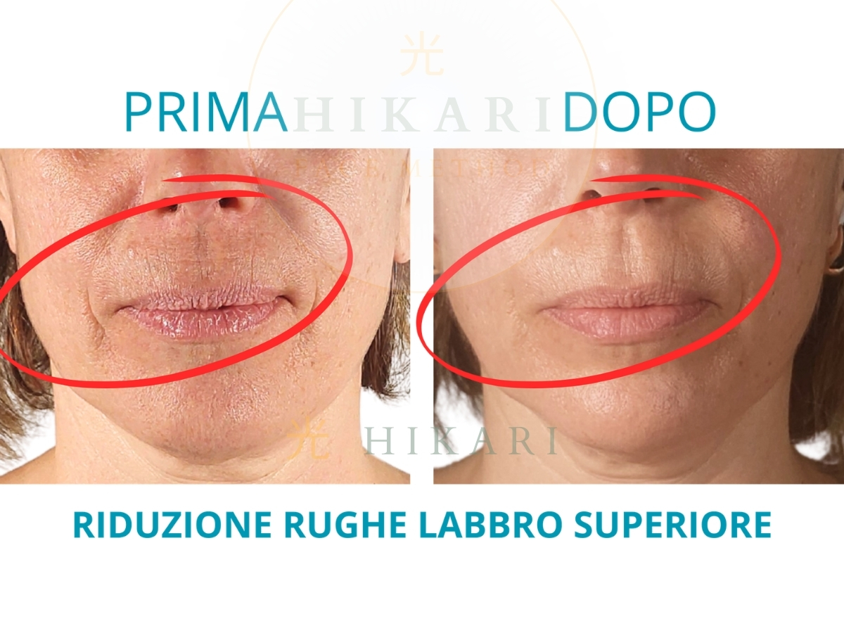 Prima e Dopo - Riduzione rughe labbro superiore