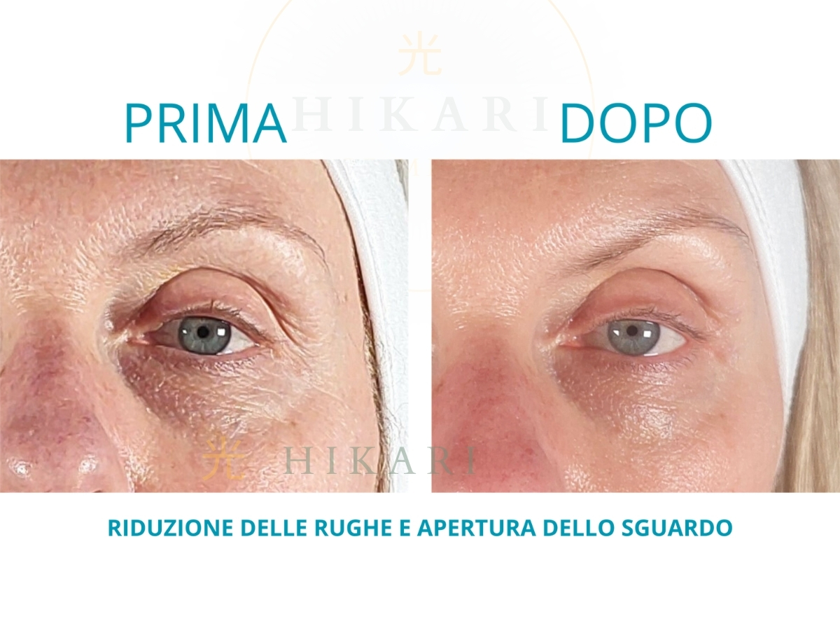 Prima e Dopo - Riduzione rughe e apertura sguardo