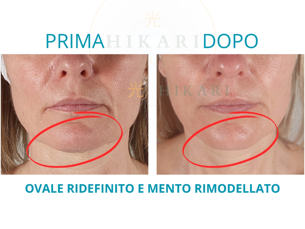 Prima e Dopo - Ovale ridefinito