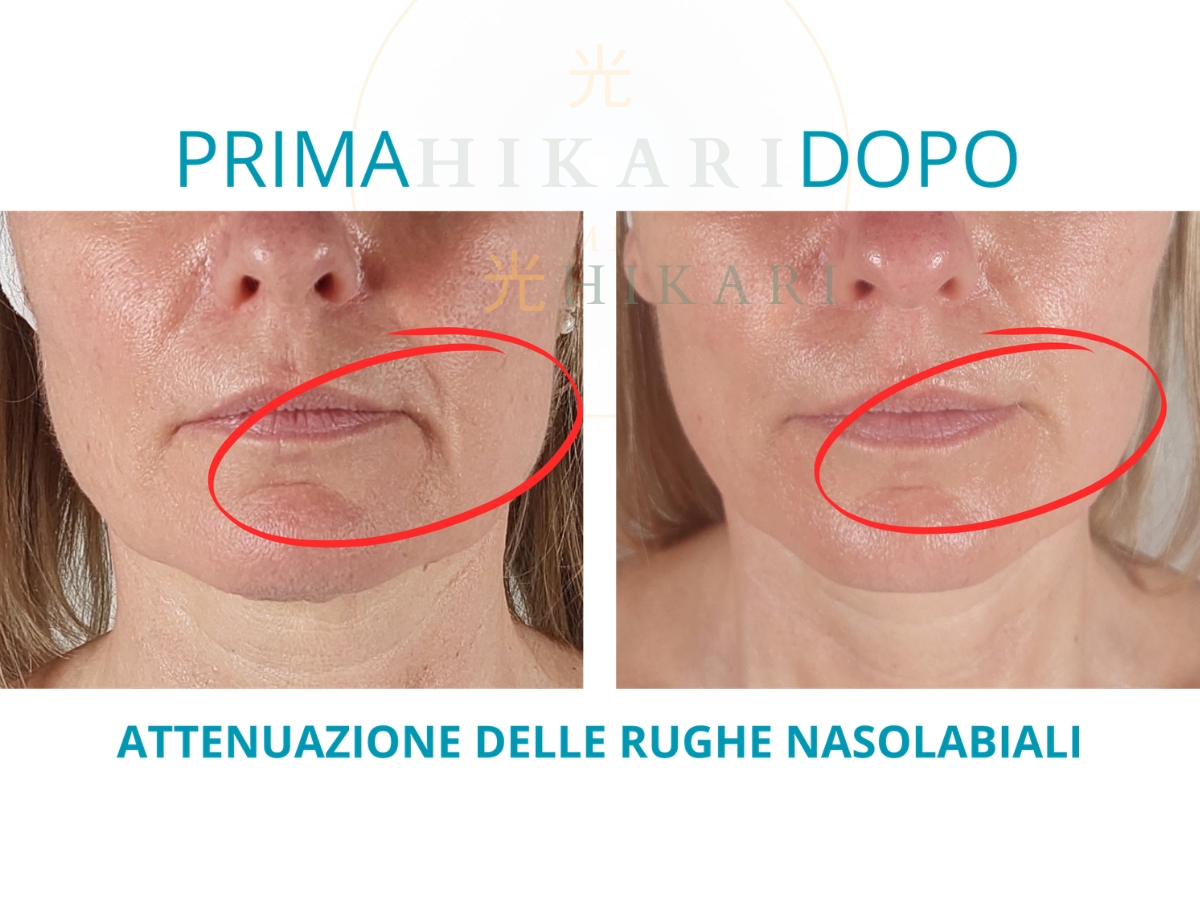 Prima e Dopo - Attenuazione rughe nasolabiali